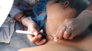 Удаление невуса на коже шеи