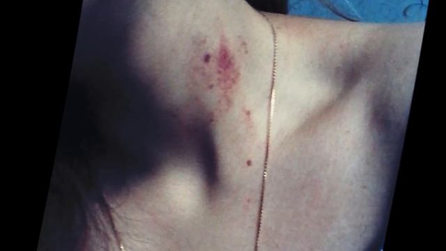 Как избавиться от засоса смотреть онлайн