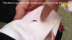 Сквозное проникновение шипа в копыто лошади, удаление шипа и перевязка