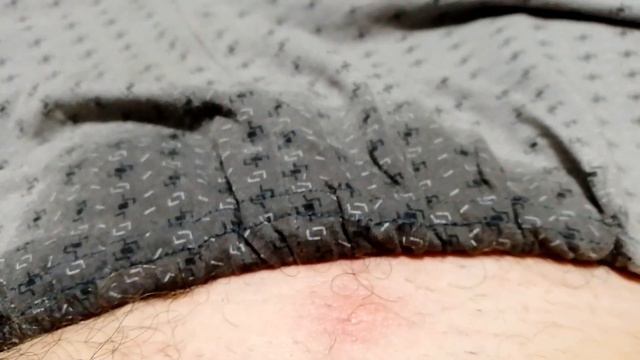 Укус  клеща,  впервый раз в жизни. Ка выглядит клещь.