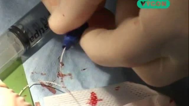 6 Постановка эпикутанно кавального катетера смотреть онлайн