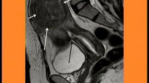 МРТ органов малого таза