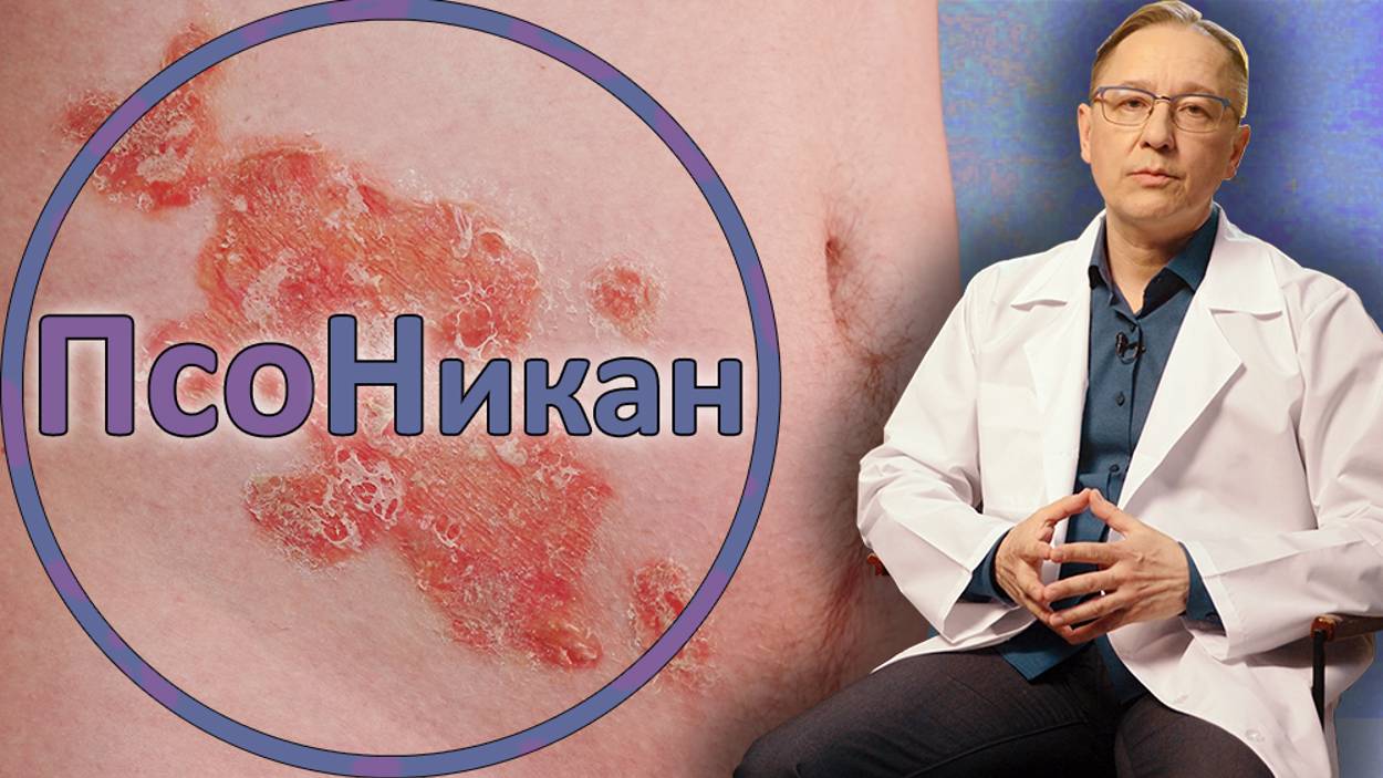 Как быстро и эффективно вылечить ПСОРИАЗ?