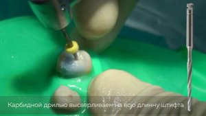Извлечение стекловолоконного штифта с помощью карбидной дрили