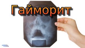 Можно ли лечить гайморит самостоятельно?
