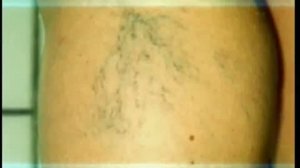 Лечение варикоза: лазерное удаление сосудистых звездочек