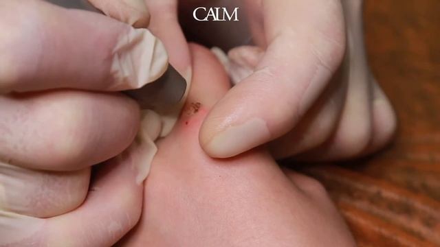 Удаление бородавки лазером смотреть онлайн