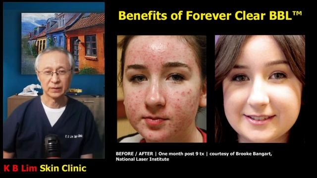 Forever Clear BBL™ (FCBBL) смотреть онлайн