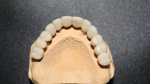 Имплантация при полном отсутствии зубов.Верхняя челюсть. Концепт All-ON-4.