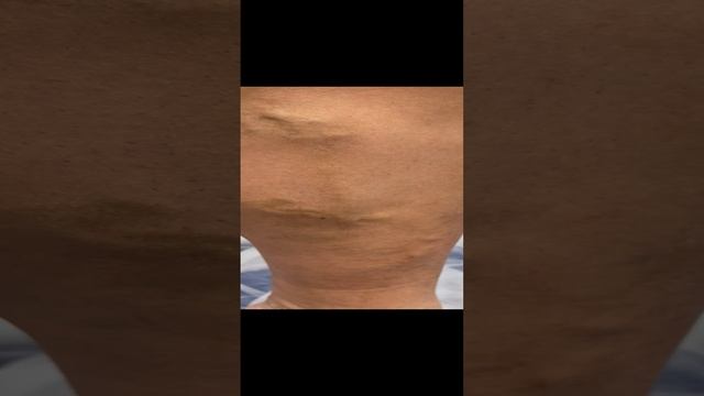 Варикоз у мужчины. Как лечить варикоз? Лечение варикоза. Флеболог Москва. Флеболог смотреть онлайн