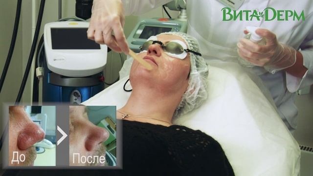 Видео для медицинского центра ВитаДерм, процедура «Фотоомоложение» смотреть онлайн