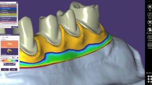 exocad Quick Guide: Using the Cutback Library "Thimble"