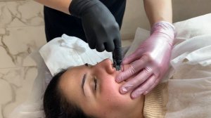 Шугаринг. Лицо.