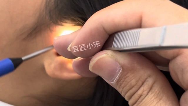 患者の耳の不快感を軽減し、大きな耳垢を掘り出します。 смотреть онлайн