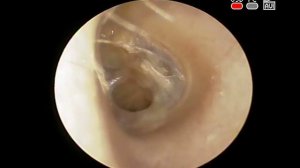 Хронический средний #отит перфорация барабанной #перепонки Chronic #otitis media