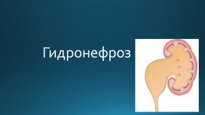 Гидронефроз