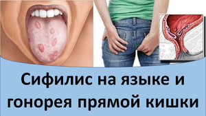 Сифилис на языке и гонорея прямой кишки