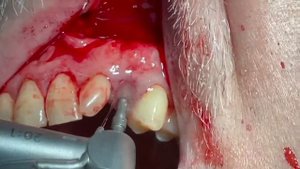 Удаление ретенированного зуба.