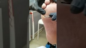 Обработка множественных стержневых мозолей "глазками" и фрезами; подолог Ольга Кострюкова (Саранск)