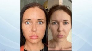 Растворила филлер под глазами и потеряла лицо