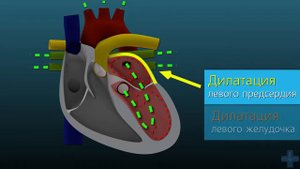 Дилатационная кардиомиопатия  Патогенез  Dilated Cardiomyopathy 3D