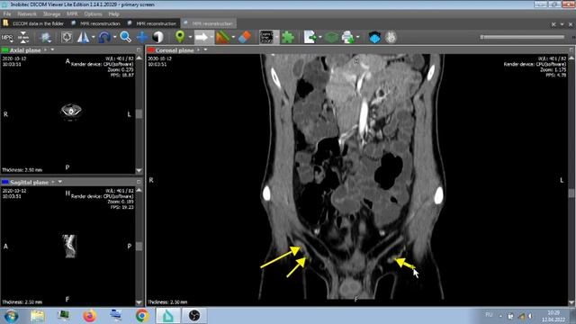 КТ АНГИОГРАФИЯ . ЗАВОРОТ 2020 Г смотреть онлайн