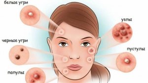 ПРИЧИНЫ ПОЯВЛЕНИЯ ПРЫЩЕЙ И ПЯТЕН НА ЛИЦЕ И КАК ОТ НИХ ИЗБАВИТЬСЯ