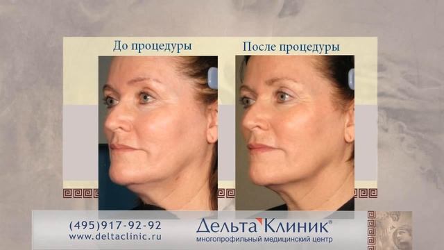 Hifu U-one SMAS lifting Смас лифтинг смотреть онлайн