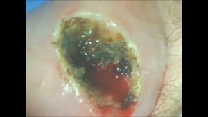 Лазерная аблация кровящей декубитальной язвы