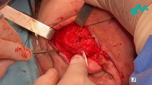 Удаление плеоморфной аденомы околоушной слюнной железы слева. Профессор Орлов А.А.