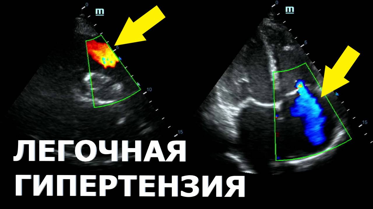 Как вычислить легочную гипертензию? смотреть онлайн