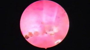 Удаление полипа лазером.