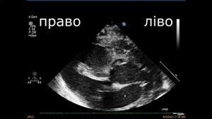 Ехо КГ з аналізом транспозиція магістральних судин