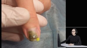 Рубрика "Тяжелый случай": онихолизис (отслойка ногтя) + синегнойная палочка