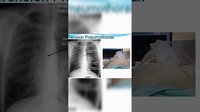 #pneumothorax