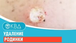 Удаление родинки. Клинический случай №89