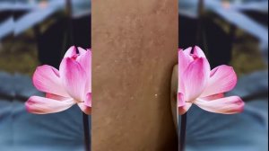 Выдавливание чёрных точек НОВОЕ! Удаление чёрных точек за ухом. p1