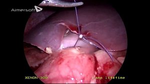 перфоративная язва передней стенки луковицы 12 п.к.