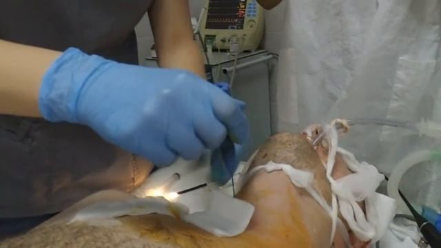 Пункционно-дилятационная трахеостомия. смотреть онлайн