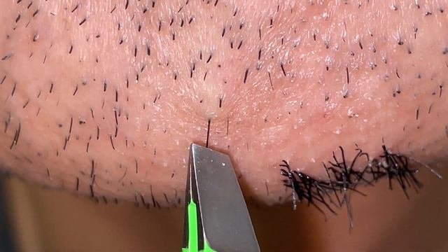 Plucking Facial Hair 196 顎髭抜き