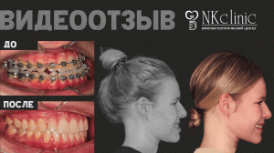 Честный отзыв пациента об исправлении асимметрии лица и неправильного прикуса.