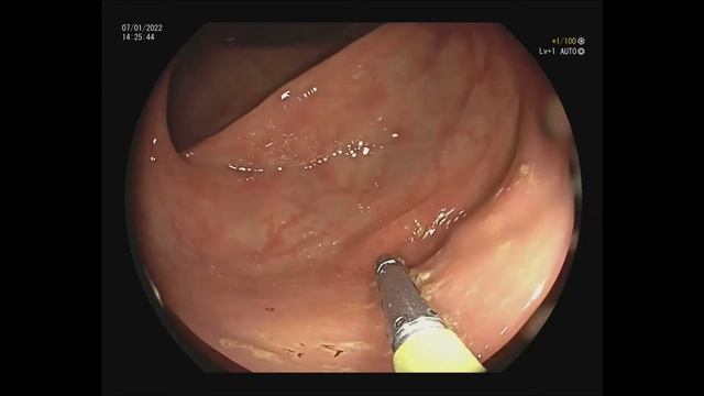 Опорожнение дивертикула смотреть онлайн
