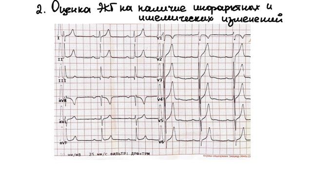 3 простых шага в анализе ЭКГ. Понятный алгоритм анализа ЭКГ. смотреть онлайн