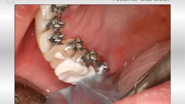 posterior bite block смотреть онлайн