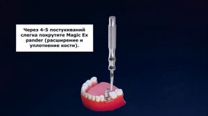 IBS IMPLANT  Техника B E B на русском