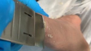 Callus removal from feet&Foot scraping dead skin【Xiao Yan pedicure】#stress 43