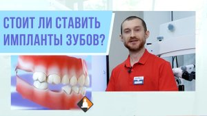 Стоит ли ставить импланты зубов?