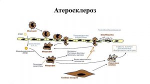 Лекция 10.3. Атеросклероз