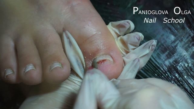 ОНИХОЛИЗИС на больших пальцев ног.ПРОТЕЗИРОВАНИЕ И зачистка часть 2 смотреть онлайн
