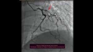 Миниинвазивное аортокоронарному-коронарное шунтирование MIDCAB c торакоскопическим забором ВГА